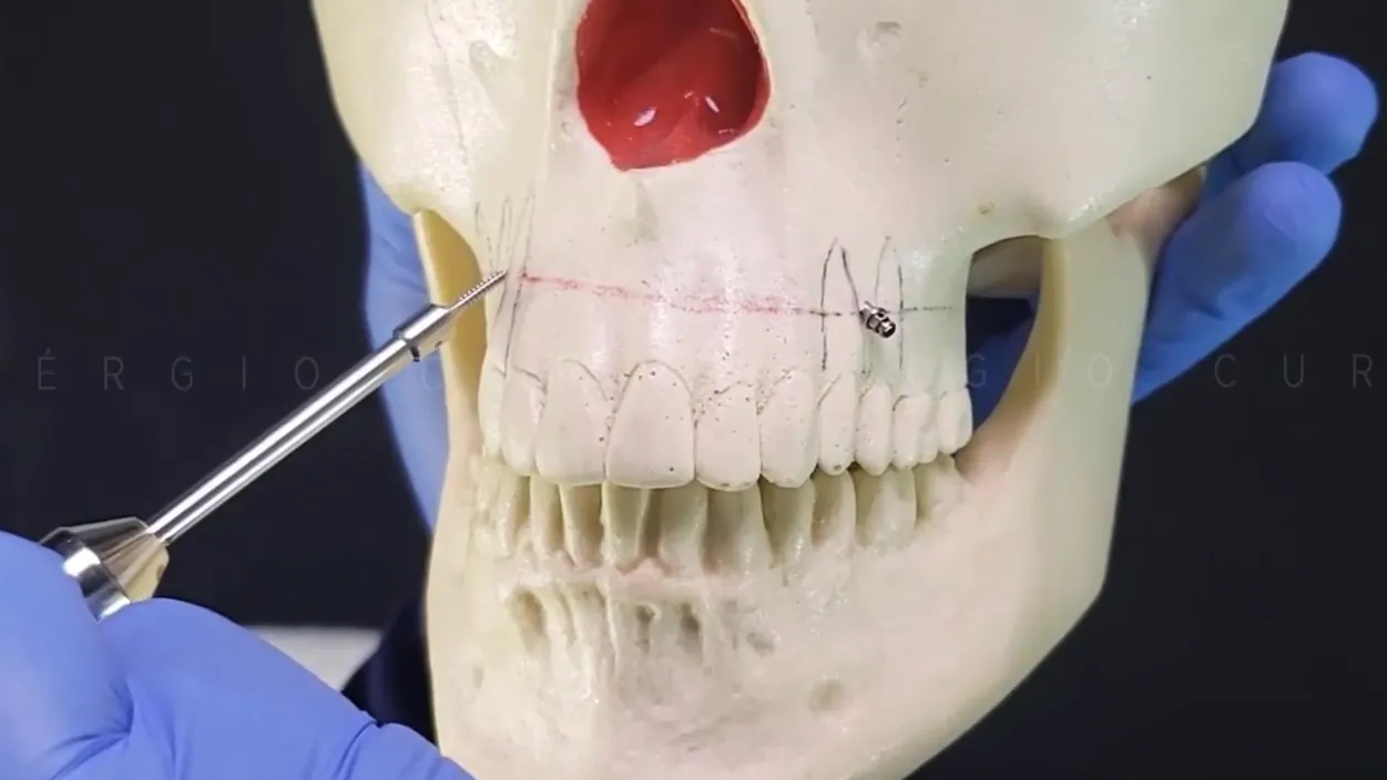 Instalación de un mini-implante en maniquí durante la práctica